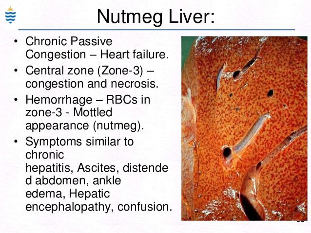Nutmeg Liver Gross Description - Case 22