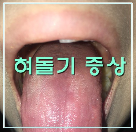 혀 밑의 돌기