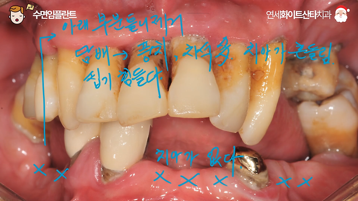 서현역 치과? 임플란트 수술 전 꼭 알아야 할 사항 1