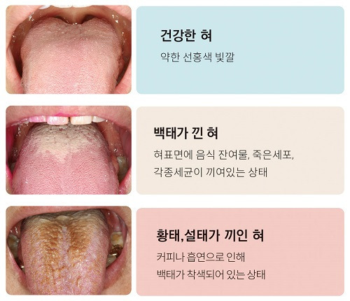 구취 입냄새 구강위생 양치질 혀청소 치과검진 구취예방 건강한습관 포스트 썸네일