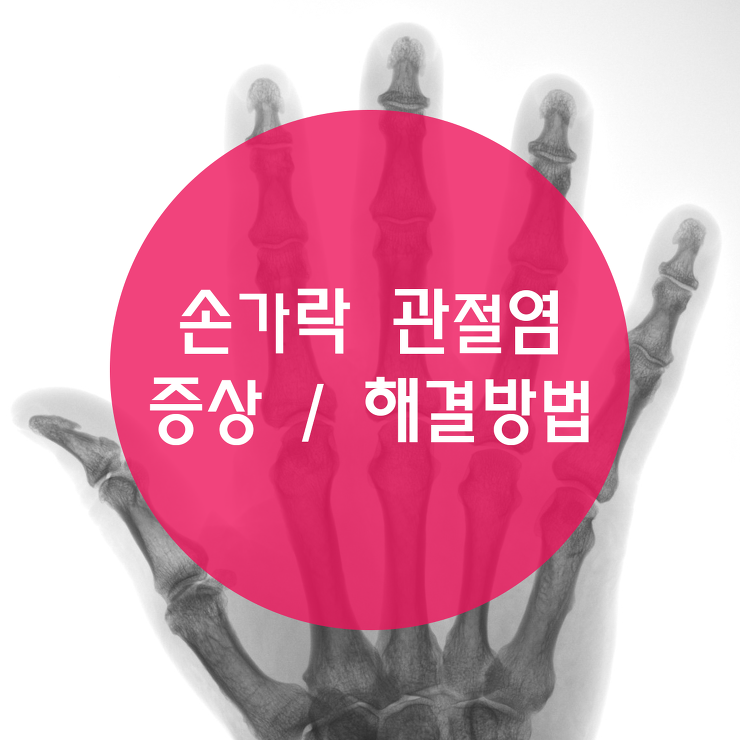 [꿀팁] 손가락 관절염 증상과 해결방법 포스팅 썸네일 이미지