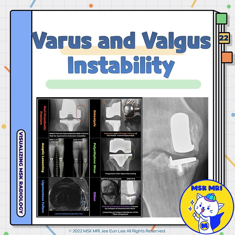 (Fig 5-D.22) Varus and Valgus Instability After TKA