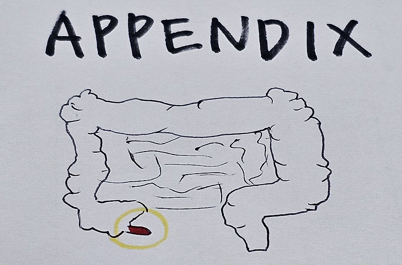 맹장염(충수돌기염; Appendicitis)의 원인, 증상, 진단 및 치료
