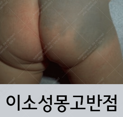 이소성몽고반점 어디서 얼마에 치료할까? :: 가오만사성