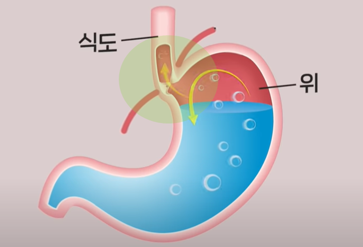 역류성 식도염에 좋은 음식 11가지