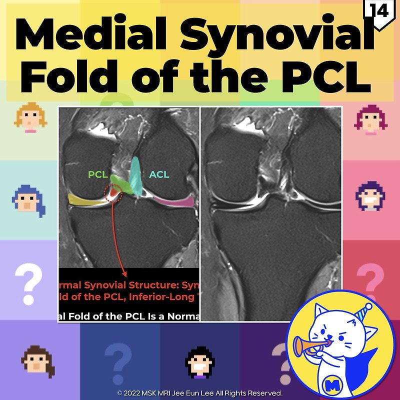 (fig 4-c.14) Medial Synovial Fold Of The Pcl