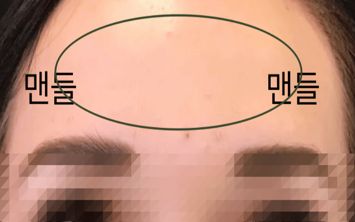 이마 보톡스 시술의 주름 효과 주기와 가격 및 부작용은? 10