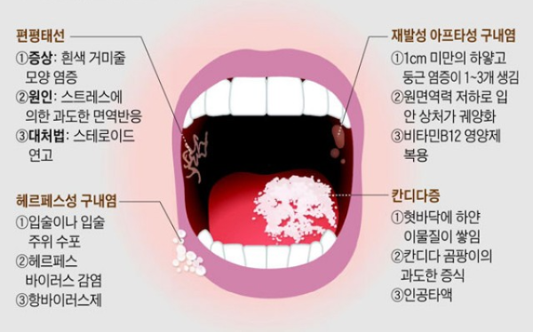 입 속에 생기는 구내염, 증상별 치료 방법 알아보기