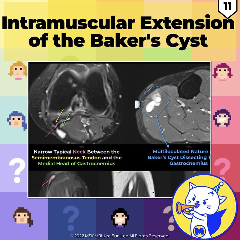 (fig 4-d.11) Intramuscular Extension Of Baker's Cyst