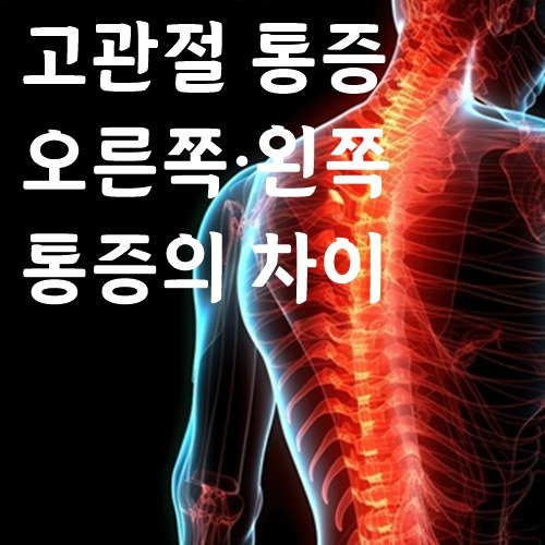 고관절 통증 증상과 오른쪽·왼쪽 통증의 차이
