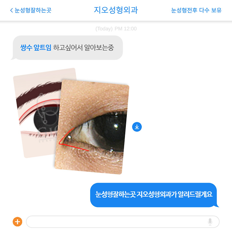 쌍수 앞트임 비용, 눈성형전후 등 다양한 정보