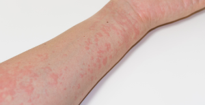 肝臓のイラスト 薬剤性肝疾患