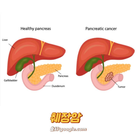 췌장암 초기증상 검사방법
