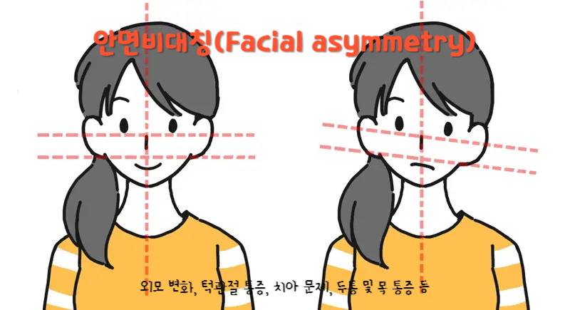 얼굴 좌우 비대칭? 안면비대칭 증상과 치료법 총정리