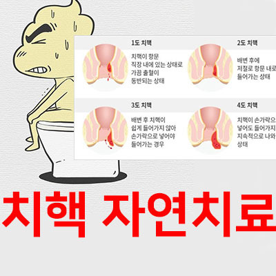 치질의 증상을 잡으려면 치질 연고를 사용하는 것이 좋습니다! 2