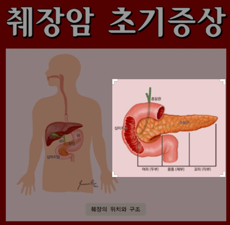 췌장암 초기증상과 검사방법, 4기 생존율, 좋은음식에 대해 알아봅시다