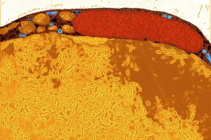 지방 세포가 암 치료의 새로운 무기가 될 수 있을까? 🧬🔬