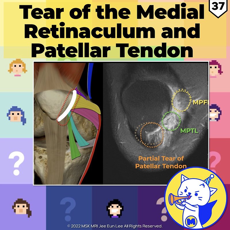 (Fig 4-A.37) Tear of the Medial Retinaculum and Patellar Tendon