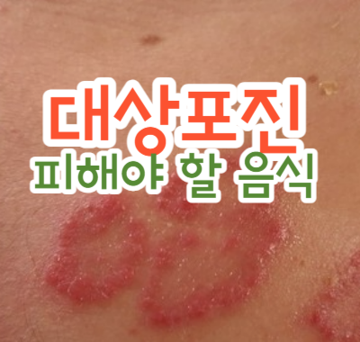 대상포진 피해야 할 음식