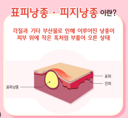 표피낭종(피지낭종, 표피낭종, 표피양낭)