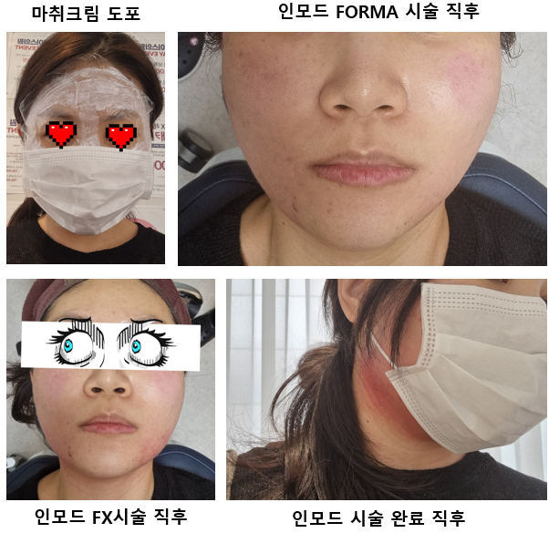 강남역 피부과에서 인모드 내 금내산 후기 2