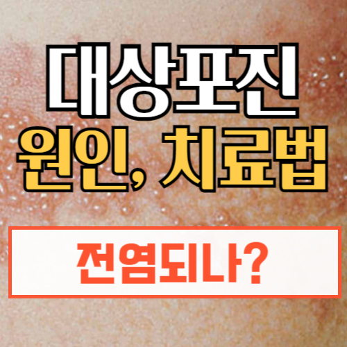 대상포진 전염될까? 원인, 증상과 치료방법, 예방접종까지 총정리!