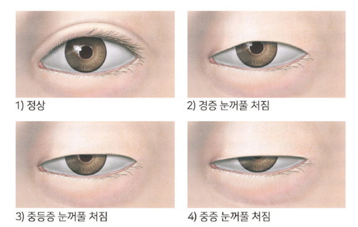 남자 안검하수 눈매교정 1달 후기 (+ 국소마취 고통)