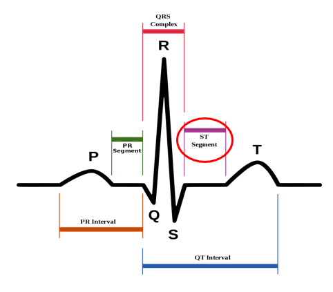 ST elevation (ST분절 상승) :: BioinformaticsAndMe