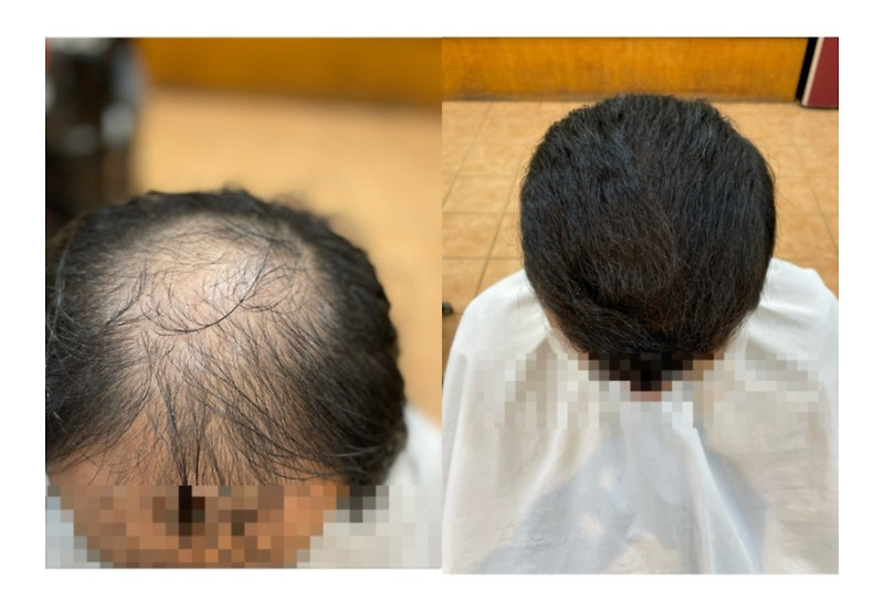 대머리남자탈모 리얼대변신 부산사상구추천미용실 머리잘하는탈모커버펌헤어스타일르네시떼헤어숍탈모컷에서펌염색복구클리닉두피케어탈모케어원스톱 원탑관리
