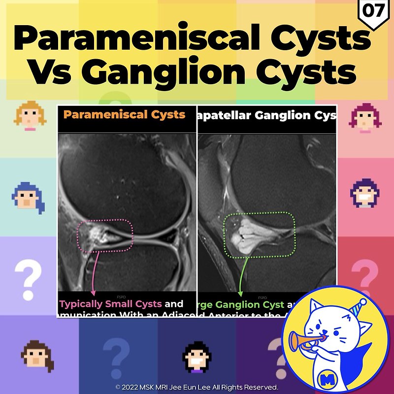 (fig 4-d.07) Comparison Of Parameniscal Cysts And Infrapatellar 