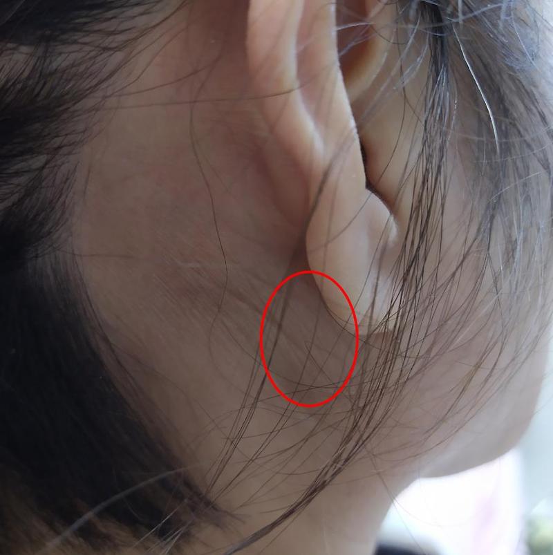둥글게 세상을 사는 법 :: 귀 뒤쪽 통증 피지낭종 의심해라