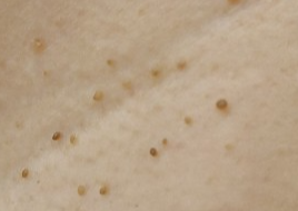 [쥐젖] 정의, 원인, 증상, 진료과, 치료 방법, 주의사항 및 예방조치, 결론 - 건강하게 행복하게