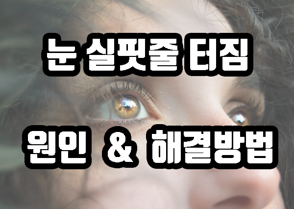 눈실핏줄터짐 원인 및 해결방법