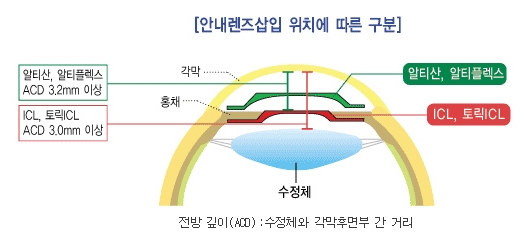 핵심만 정리한, '렌즈삽입술'후기 (광고X)
