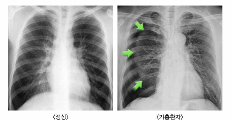 기흉 - 증상, 진단, 치료에 대하여
