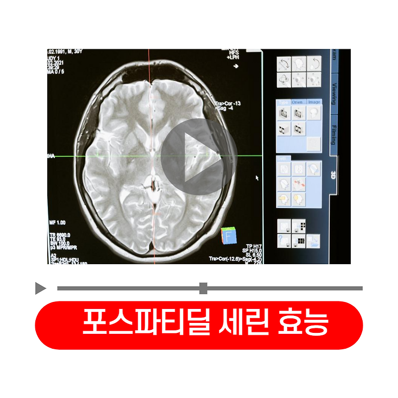 포스파티딜 세린 효능