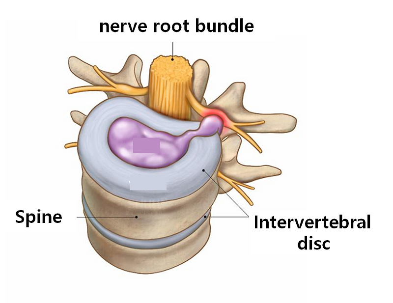 About the Cauda Equina Syndrome