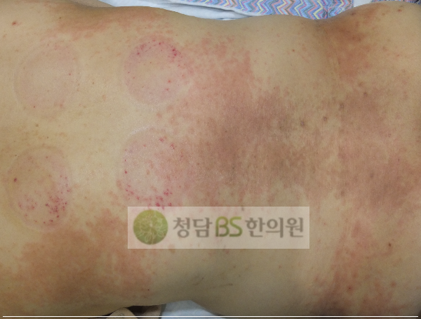 즐거운 해외여행, 밤에 잘 수 없는 가려움과 피부 발진