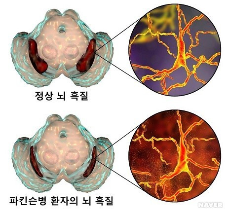 파킨슨 병의 모든 것 정의 원인 증상 진단/검사 치료 합병증, 초기'갱년기인 줄'