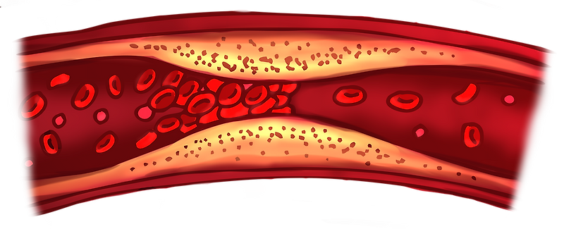 정맥혈전증(Deep Vein Thrombosis, DVT)): 원인, 증상 및 예방법