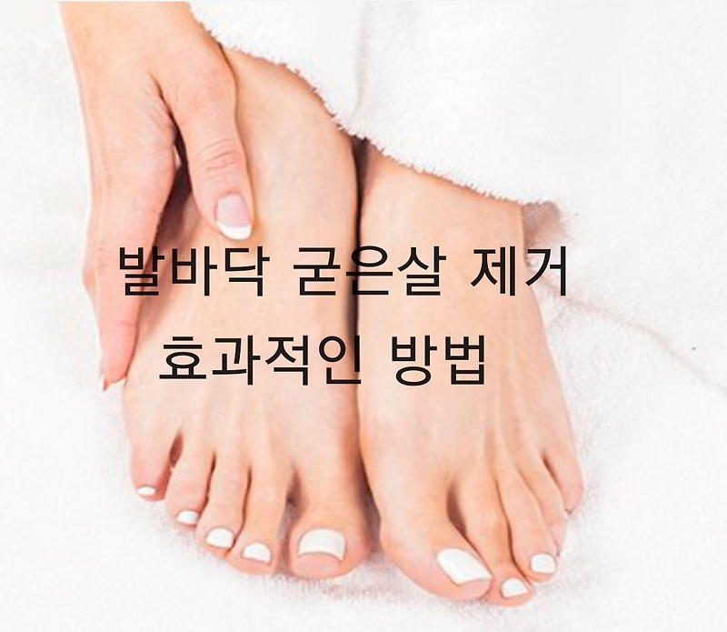 발바닥 굳은살 제거 값싸고 효과적인 방법 12가지