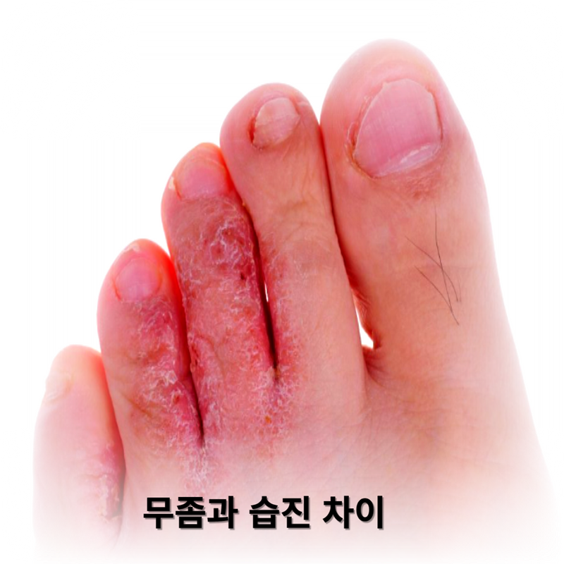 가려움증의 두 주범, 무좀과 습진 차이