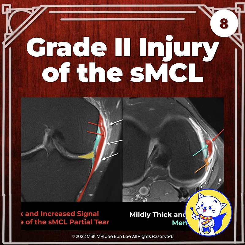 (Fig 3-A.08) Grade II injury of the superficial medial collateral ...