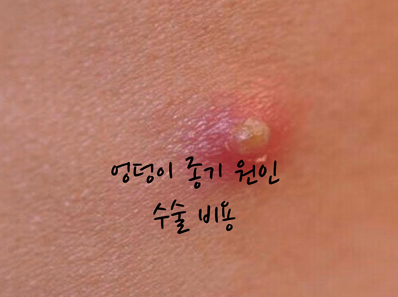 엉덩이 종기 수술 비용 병원 외과