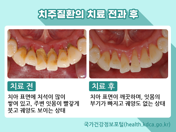 잇몸치료로 치아를 건강하게 관리하자 🦷