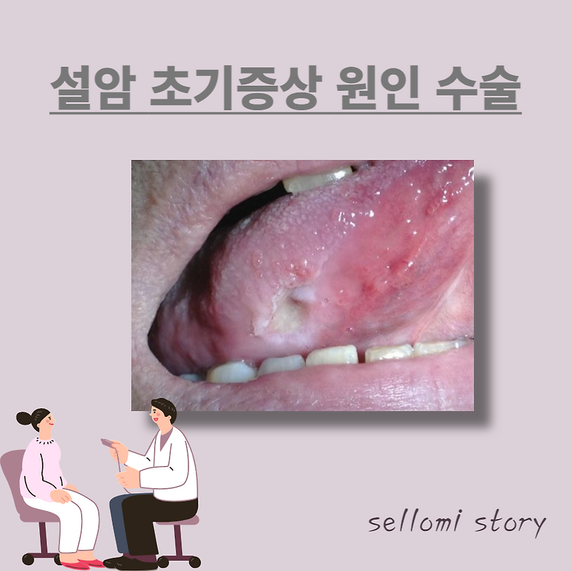 설암(혀암) 초기증상 원인 사진 치료 수술 생존율 미스트롯 정미애 :: 셀로미