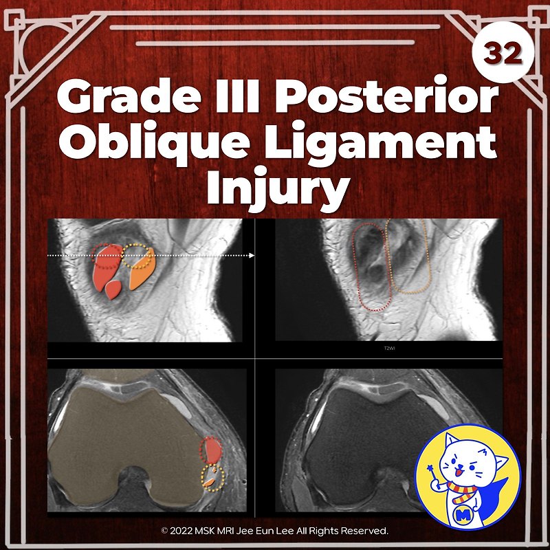 (Fig 3-A.32) Grade III Posterior Oblique Ligament Injury