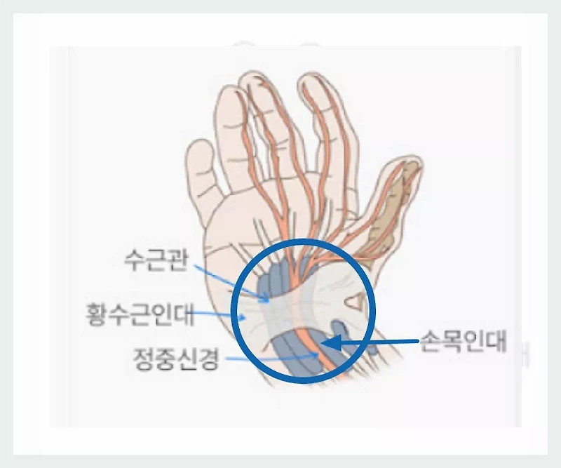 손목 인대 늘어남 증상과 빠른 회복 방법