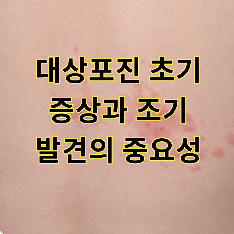 대상포진 초기 증상과 조기 발견의 중요성
