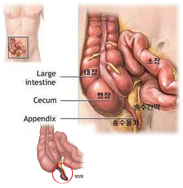 충수염(Appendicitis) 이란?